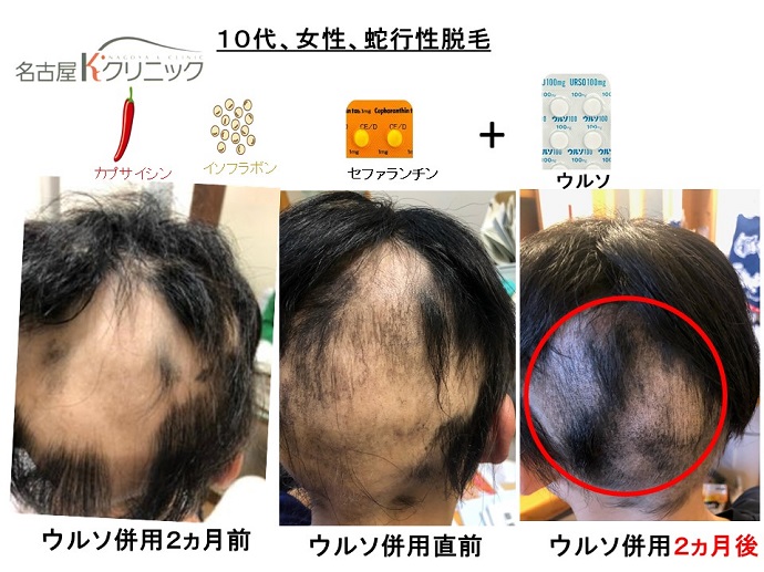 円形脱毛症　病院